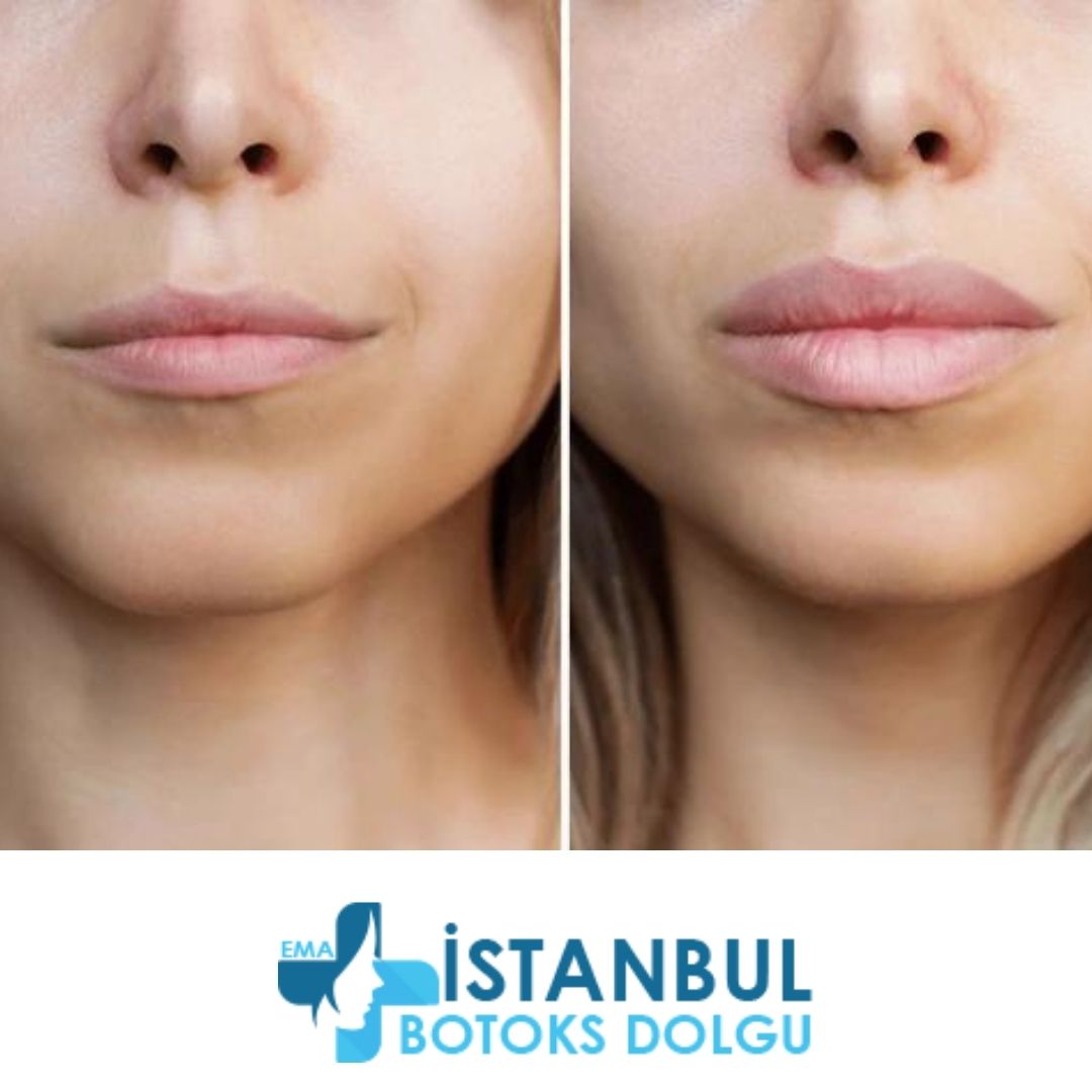 Dolgu vücuttan ne zaman atılır? Dolgu vücuttan ne zaman atılır?