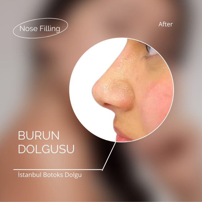 Yüz dolgusu kaç ayda bir yapılır? Yüz dolgusu kaç ayda bir yapılır?