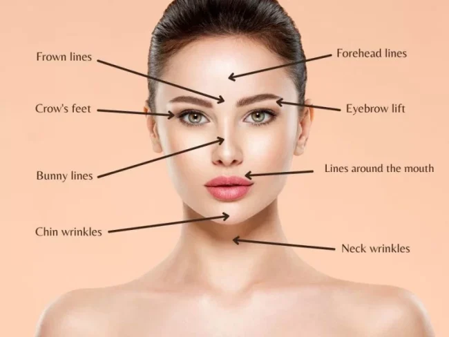 Botoks sonrası kas ne zaman kalkar?