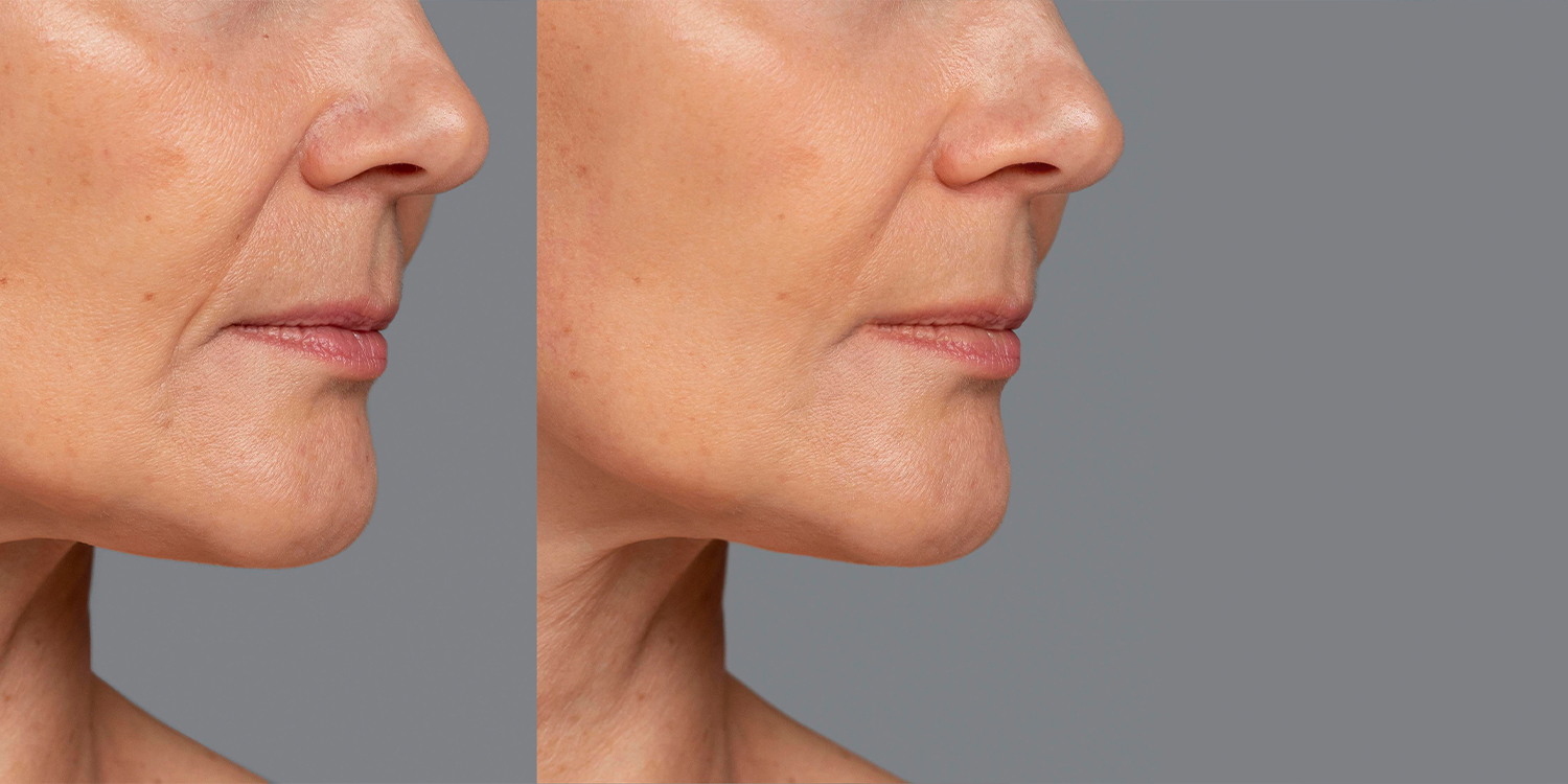 Botoks kaç sene gider? Botoks kaç sene gider?