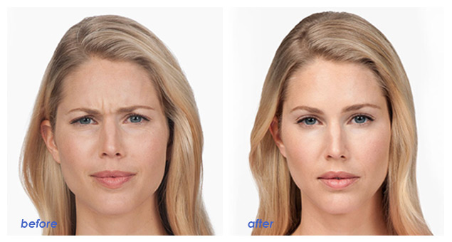 Dudak dolgusu genç gösterir mi?