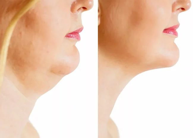 Gıdı Eritme Gıdı Eritme