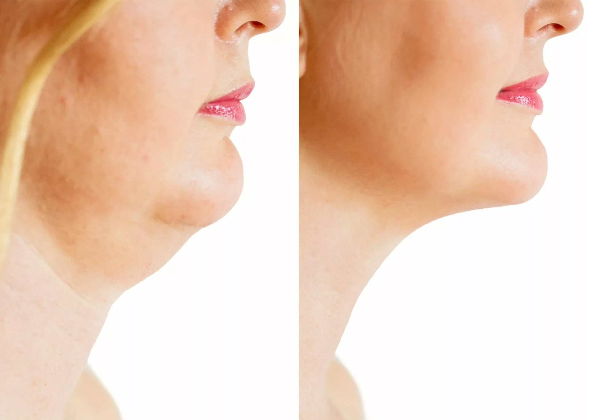 Gıdı Eritme Gıdı Eritme